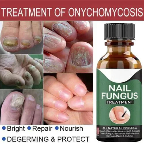 Nail Fungus Treatment -Advanced Antifungal Treatment